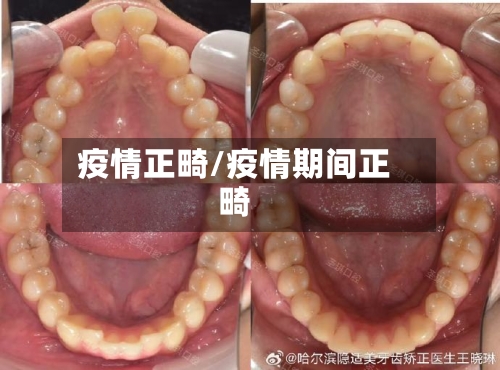 疫情正畸/疫情期间正畸-第2张图片