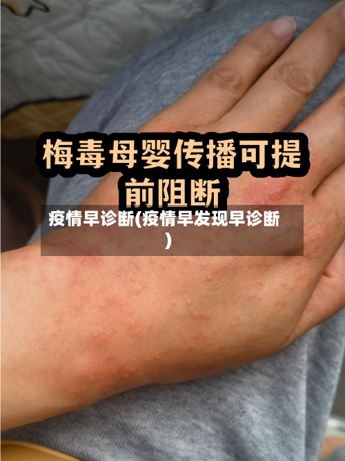 疫情早诊断(疫情早发现早诊断)