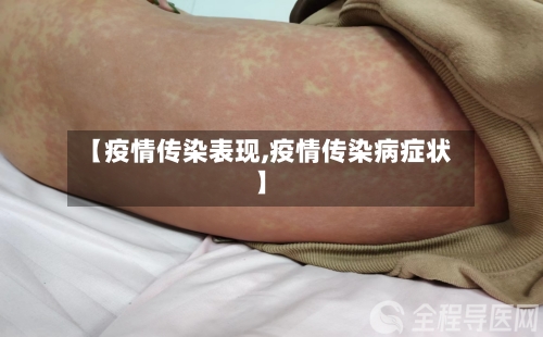 【疫情传染表现,疫情传染病症状】-第2张图片