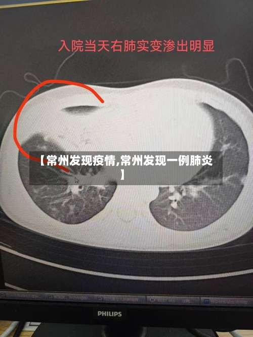 【常州发现疫情,常州发现一例肺炎】-第2张图片
